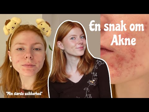 VLOG: EN SNAK OM AKNE, GENBRUGSSHOPPING OG PÅ CAFE