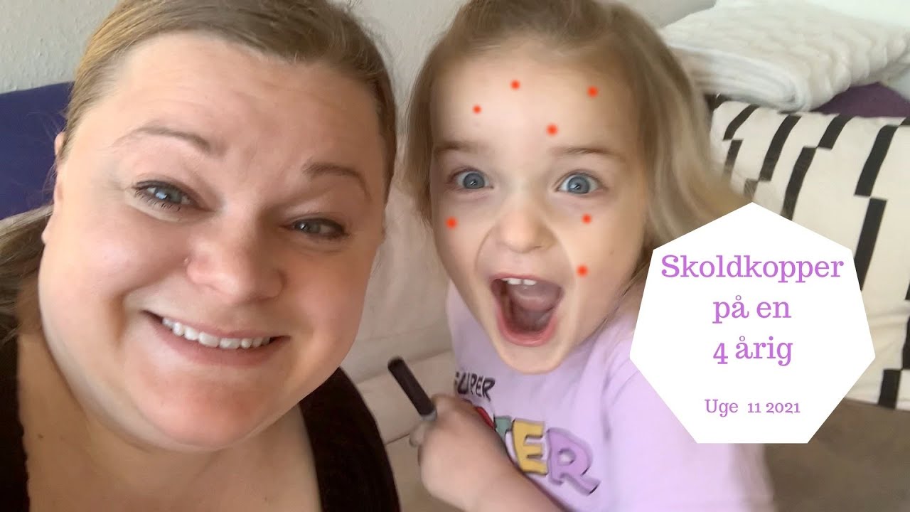 EN DAG MED SKOLDKOPPER - HALEY HAR FÅET SKOLDKOPPER