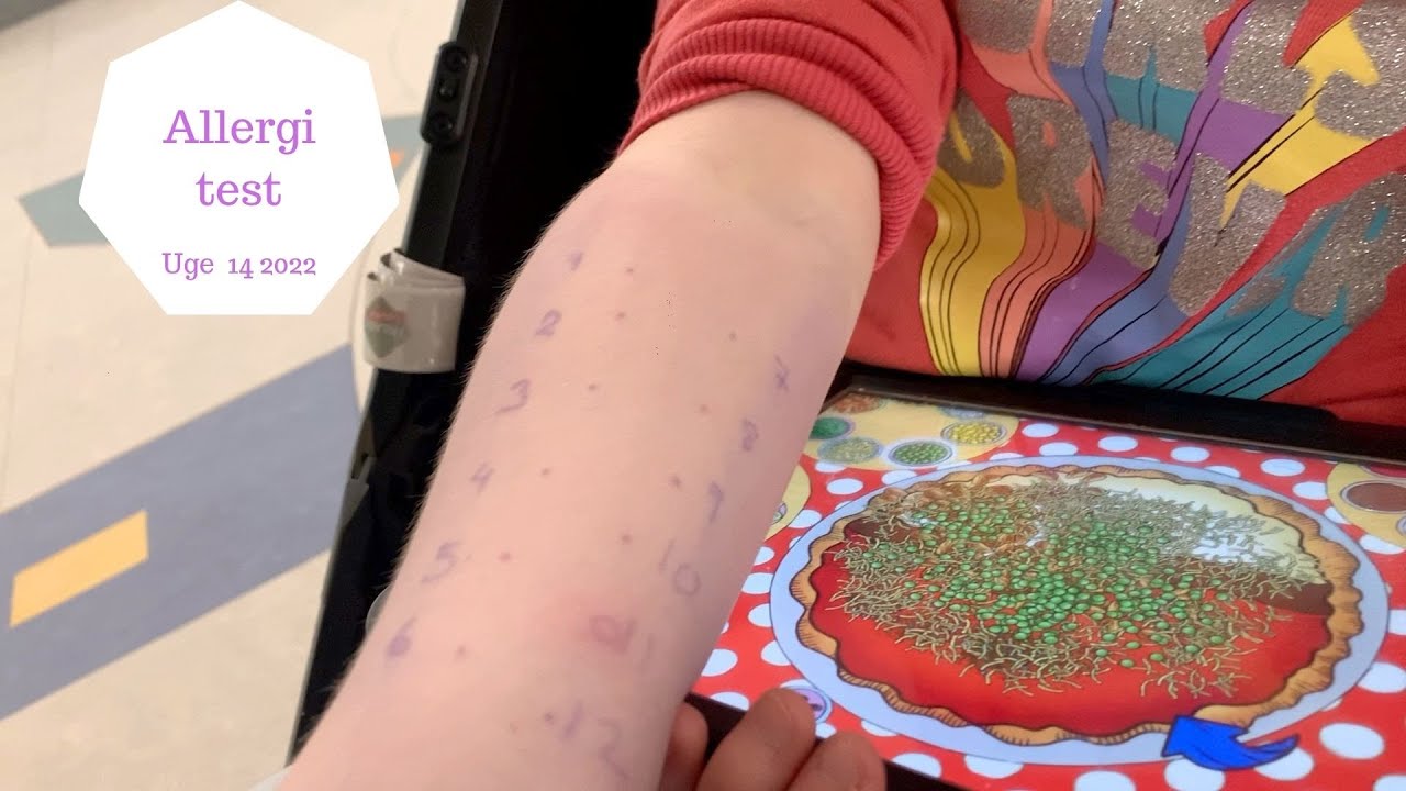 ROSKILDE SYGEHUS - HAR ZOE ALLERGI?