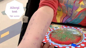 ROSKILDE SYGEHUS - HAR ZOE ALLERGI?
