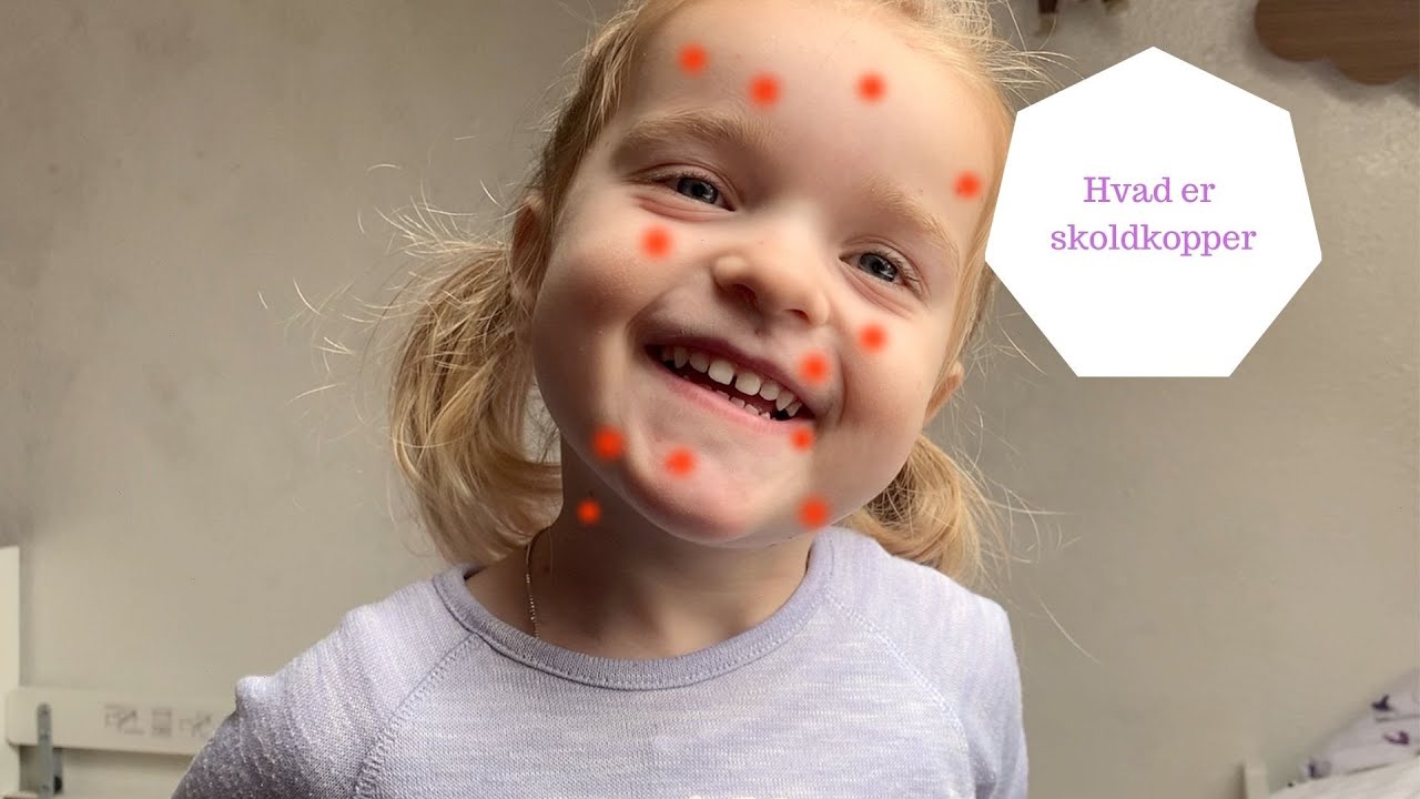 HVAD ER SKOLDKOPPER IFØLGE EN 4 ÅRIG