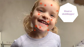 HVAD ER SKOLDKOPPER IFØLGE EN 4 ÅRIG